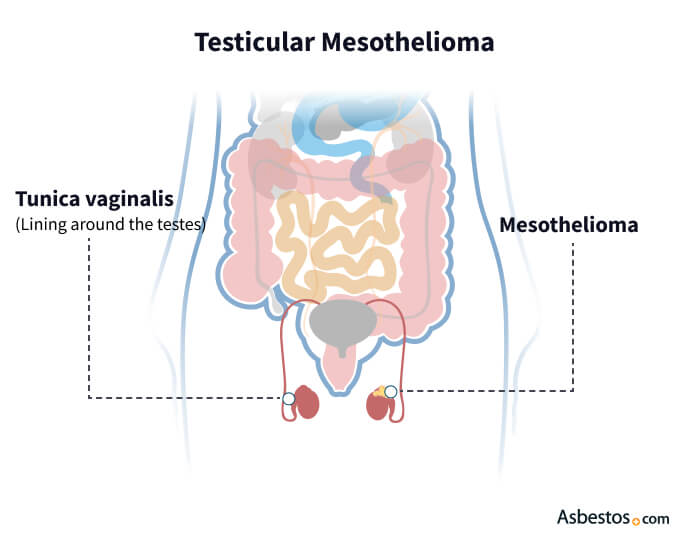 Testicular Mesothelioma, the type of mesothelioma affecting the testes
