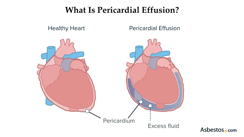 What is Pericardial Effusion?