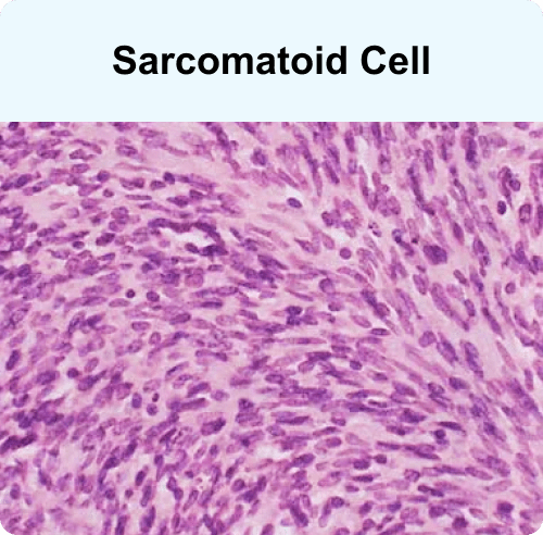 Sarcomatoid cell, a mesothelioma cell type
