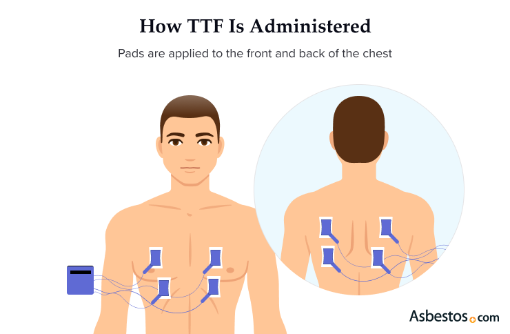 How TTFields are administered