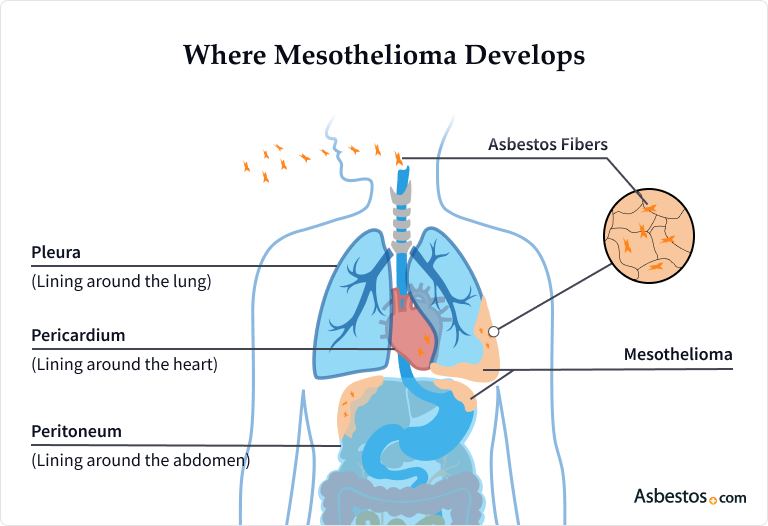Mesothelioma developing in the lungs, abdomen and heart